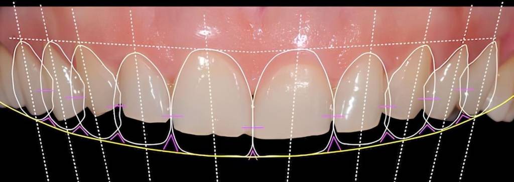 Цифровое планирование улыбки