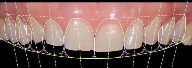 Цифровое планирование улыбки