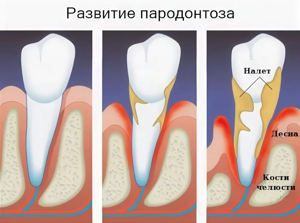 Протезирование при сильной потере костной ткани