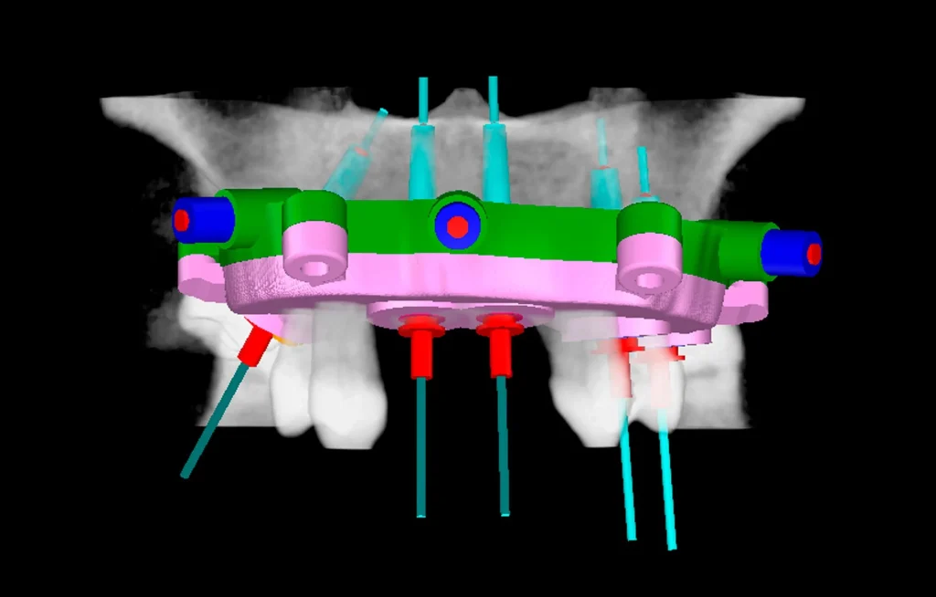 хирургический шаблон - направляющие