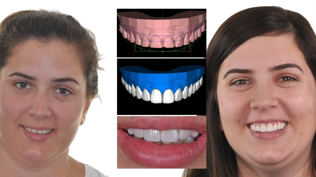 Виниры до и после