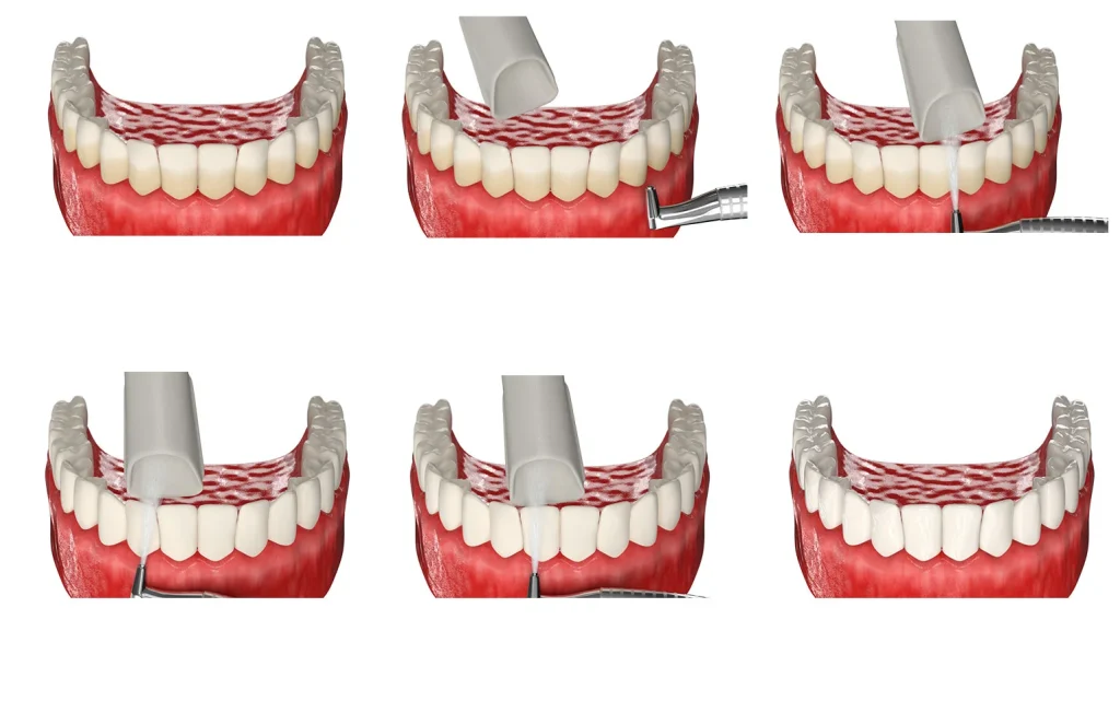 Профессиональная гигиена полости рта Air Flow