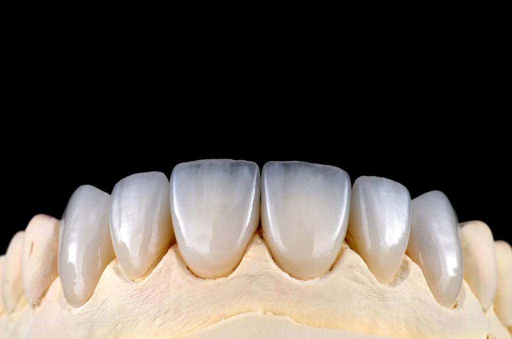 Emax Veneer