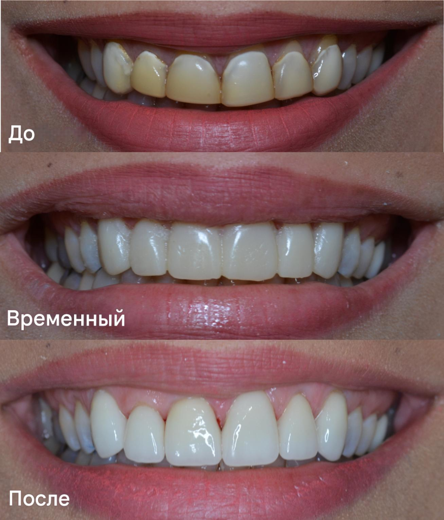 Временные виниры: стоит ли устанавливать?